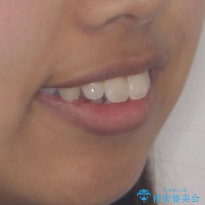 くちばしのように突出した前歯 口元を下げる抜歯矯正の治療前(顔貌)