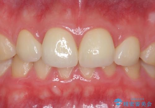 前歯の隙間を埋めたい　矯正かクラウンかの治療後