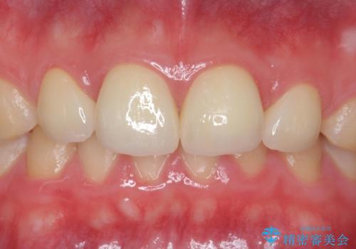 前歯の隙間を埋めたい 矯正かクラウンかの症例 治療後