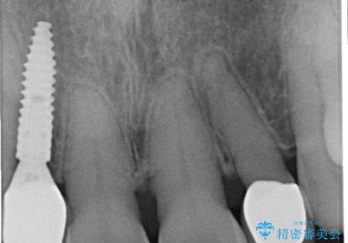アライナー矯正+インプラント治療で前歯を綺麗に並べましたの治療後