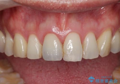 前歯の変色を改善 オールセラミック治療の治療後