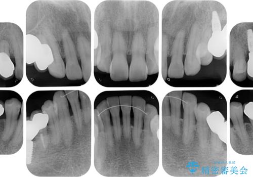 治療中で放置　インプラントでしっかりと咬めるようにの治療後