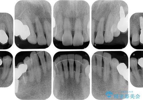 治療中で放置 インプラントでしっかりと咬めるようにの治療後