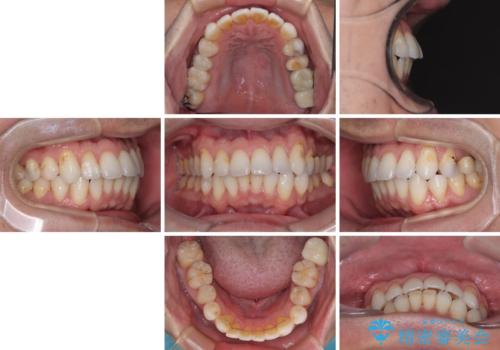 銀歯をなくしたい 全顎的なむし歯治療の治療後