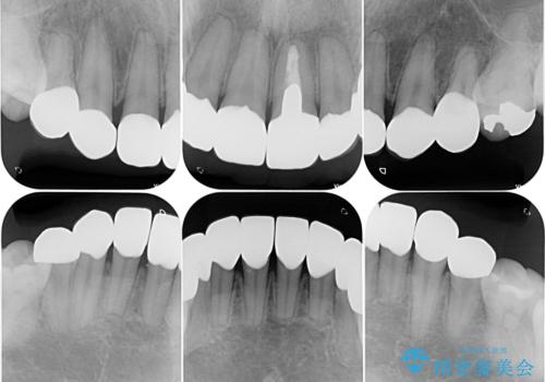 薬剤の影響で変色した歯を自然に　オールセラミッククラウンによる審美歯科治療の治療後