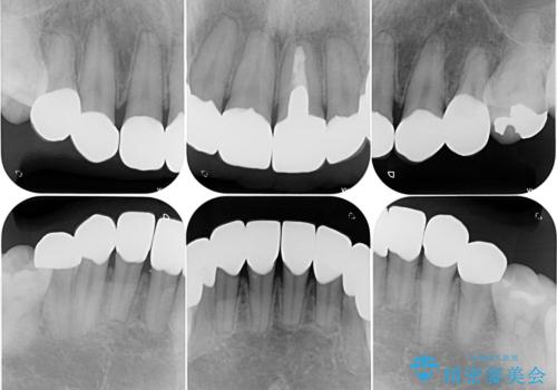 薬剤の影響で変色した歯を自然に オールセラミッククラウンによる審美歯科治療の治療後