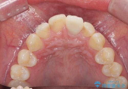 前歯の変色を改善するセラミッククラウン治療の治療後