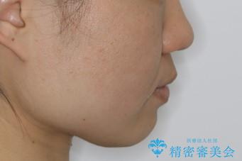 前歯のねじれと深い噛み合わせの改善:インビザライン治療の治療後(顔貌)