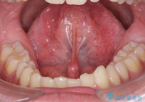 [ 舌小帯の形成術 ]  ラ行の発音を改善したいの治療前