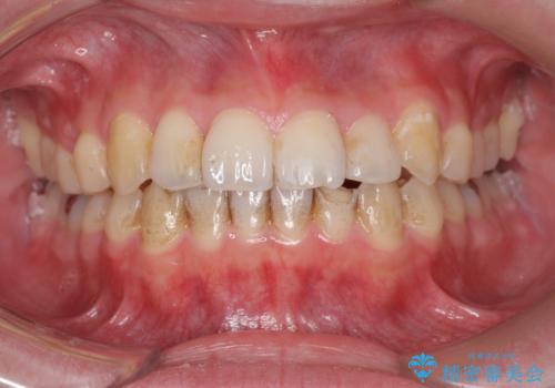 下の前歯が欠けている セラミックで審美的に エアフローで着色除去もの治療前