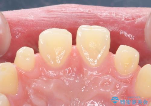 前歯の隙間を埋めたい 矯正かクラウンかの治療前