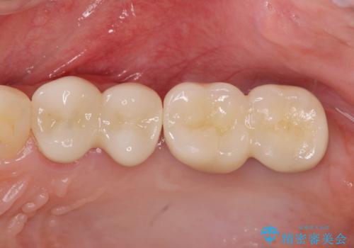 虫歯・破折の放置により重度に吸収した歯槽骨 骨造成後のインプラント治療の治療後