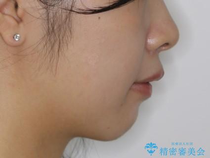 前歯のがたつきとディープバイト:インビザライン治療の治療後(顔貌)