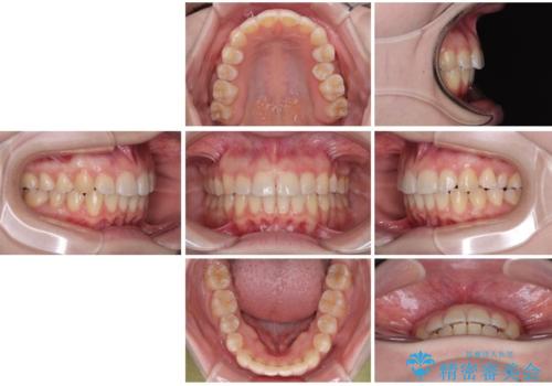 左上の前歯が出ているのが気になる　審美装置による非抜歯ワイヤー矯正の治療後