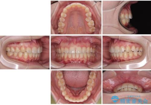 左上の前歯が出ているのが気になる 審美装置による非抜歯ワイヤー矯正の治療後