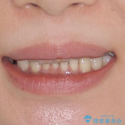 デコボコの歯とむし歯 インビザライン矯正治療とむし歯治療の治療前(顔貌)