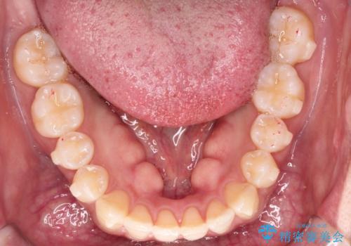 【インビザライン】前歯のでこぼこ。真ん中の位置を合わせたい。の治療中