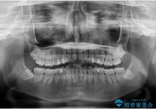 左上の前歯が出ているのが気になる　審美装置による非抜歯ワイヤー矯正の治療前