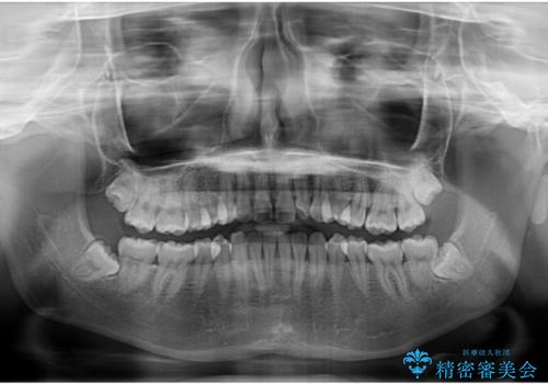左上の前歯が出ているのが気になる 審美装置による非抜歯ワイヤー矯正の治療前