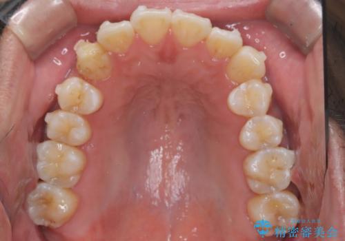 【インビザライン】前歯の凸凹を解消。の治療中