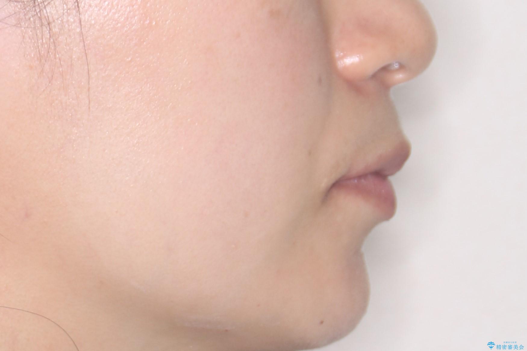 【インビザライン】前歯を下げたい。の治療後(顔貌)