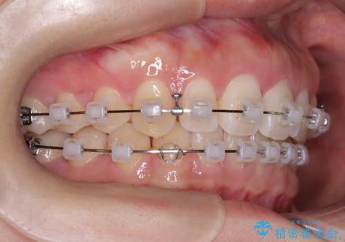 前歯の悩みを非抜歯ワイヤー矯正で改善の治療中