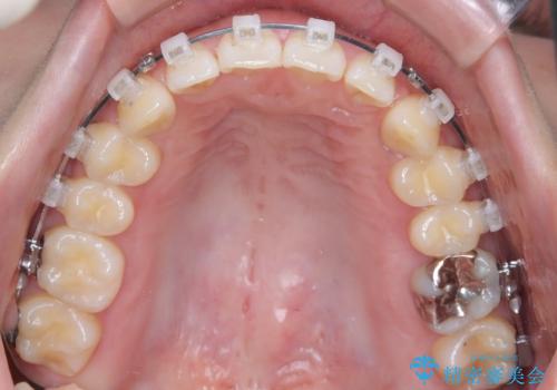 前歯の悩みを非抜歯ワイヤー矯正で改善の治療中
