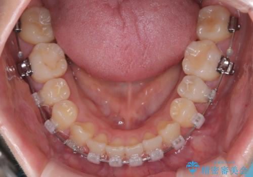 前歯の悩みを非抜歯ワイヤー矯正で改善の治療中