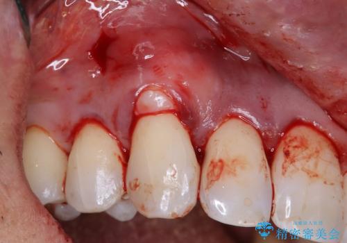 歯肉退縮が気になる方へ 歯肉移植で自然な笑顔を取り戻すの治療中