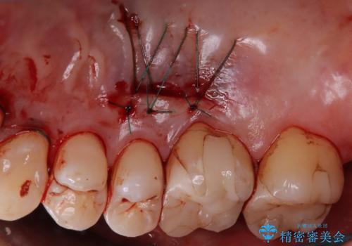 歯肉退縮が気になる方へ 歯肉移植で自然な笑顔を取り戻すの治療中
