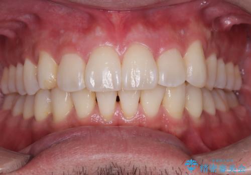 【インビザライン】前歯の凸凹を解消。の症例 治療後