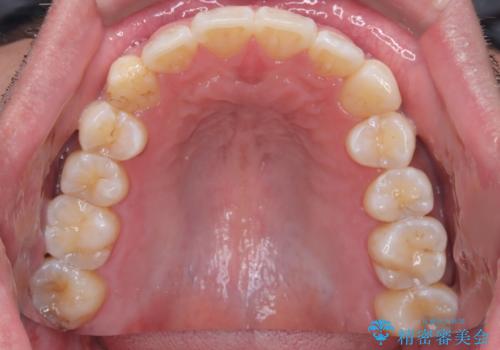 【インビザライン】前歯の凸凹を解消。の治療後
