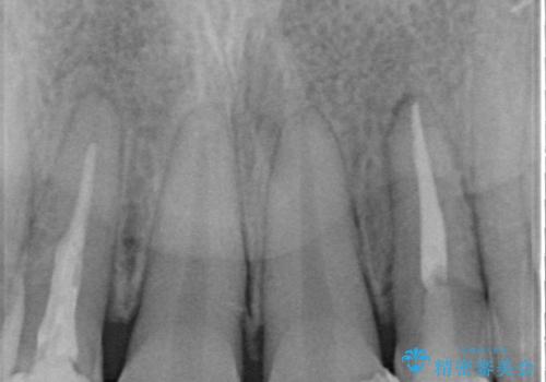 前歯をきれいにしたい　オールセラミッククラウンにによる補綴の治療前