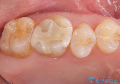 【奥歯のセラミッククラウン】他院で根管治療も必要だといわれた。の治療前