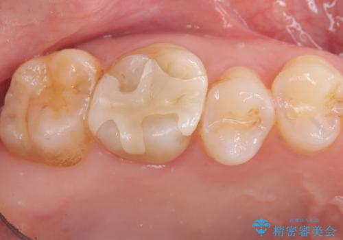 【奥歯のセラミッククラウン】他院で根管治療も必要だといわれた。の症例 治療前