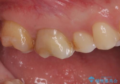 【奥歯のセラミッククラウン】他院で根管治療も必要だといわれた。の治療前
