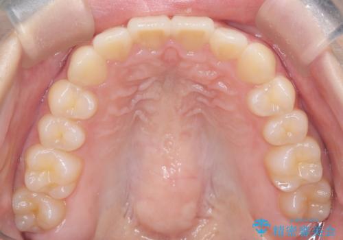 【インビザライン】前歯を下げたい。の治療後
