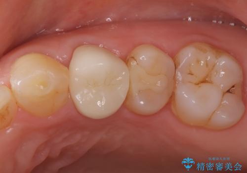 【外科的歯内療法】根管治療をしても違和感が残るの治療後