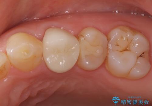 【外科的歯内療法】根管治療をしても違和感が残るの症例 治療後