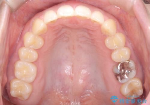 前歯の悩みを非抜歯ワイヤー矯正で改善の治療後