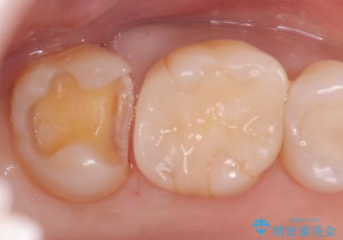 【セラミックインレー】むし歯の再発防止を考えた治療