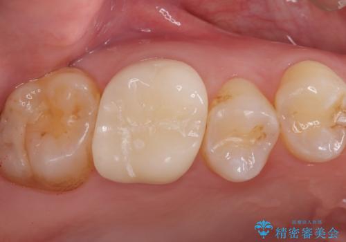 【奥歯のセラミッククラウン】他院で根管治療も必要だといわれた。の症例 治療後