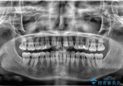 左上の前歯が出ているのが気になる　審美装置による非抜歯ワイヤー矯正の治療後