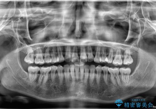 左上の前歯が出ているのが気になる 審美装置による非抜歯ワイヤー矯正の治療後