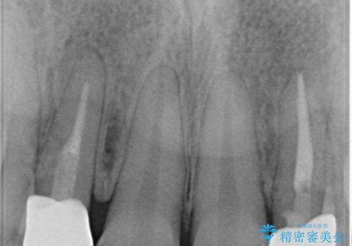 前歯をきれいにしたい　オールセラミッククラウンにによる補綴の治療後