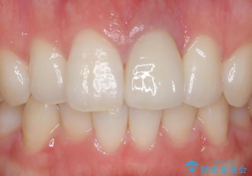 前歯が暗く変色 ジルコニアクラウンでの修復の治療後