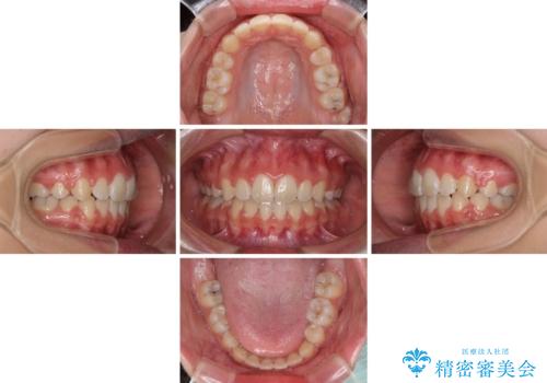 くちばしのように突出した前歯 口元を下げる抜歯矯正の治療後