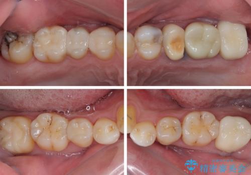 銀歯をなくしたい　全顎的なむし歯治療の治療後