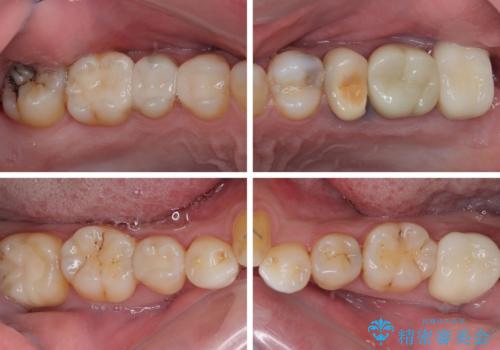 銀歯をなくしたい 全顎的なむし歯治療の治療後