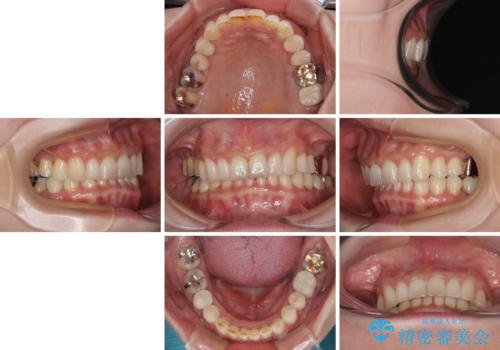 デコボコの歯とむし歯　インビザライン矯正治療とむし歯治療の治療後